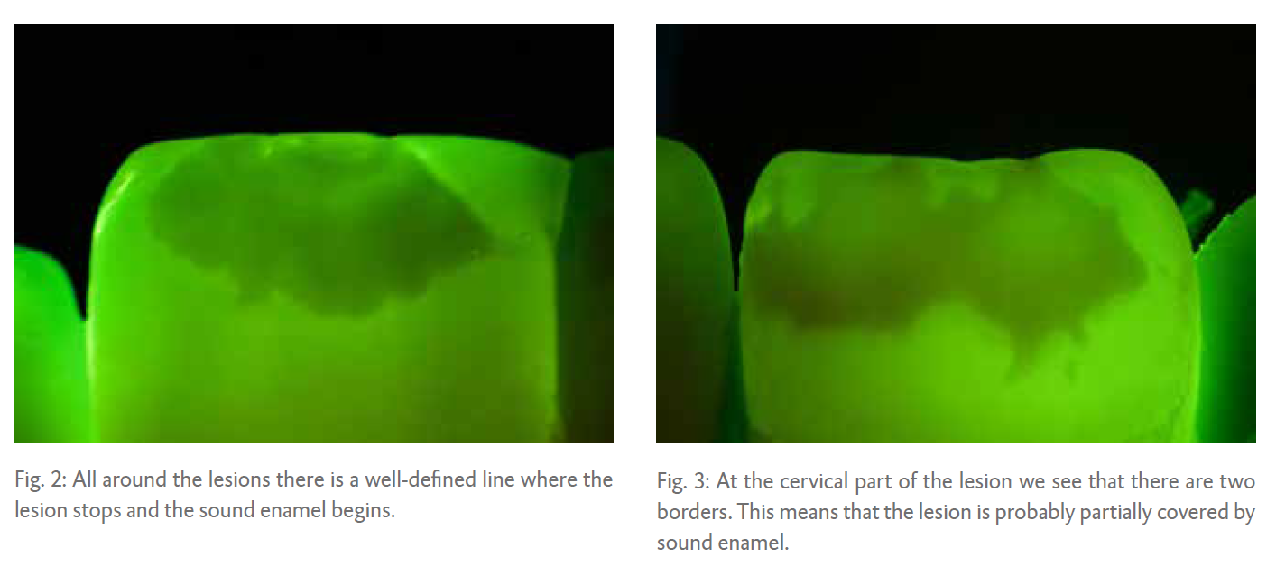 Fig. 2: All around the lesions there is a well-defined line where the lesion stops and the sound enamel begins.  Fig. 3: At the cervical part of the lesion we see that there are two borders. This means that the lesion is probably partially covered by sound enamel.